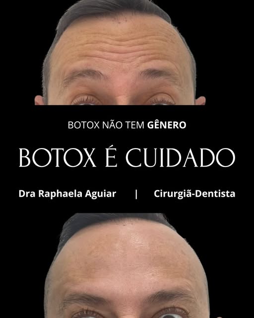 Toxina botulínica como parte do plano de harmonização facial