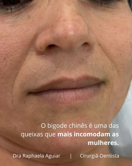 Tratamento do bigode chinês com preenchimento de ácido hialurônico