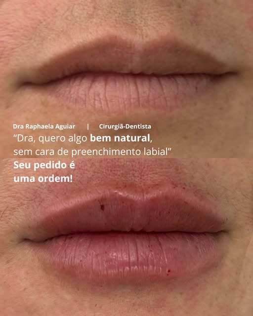 Antes e depois de preenchimento labial