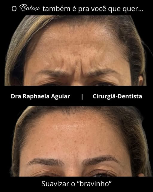 Suavização da linha entre as sobrancelhas