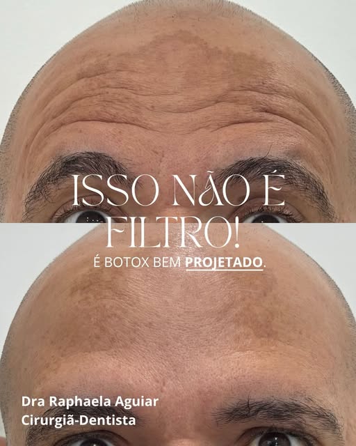Botox bem projetado — antes e depois