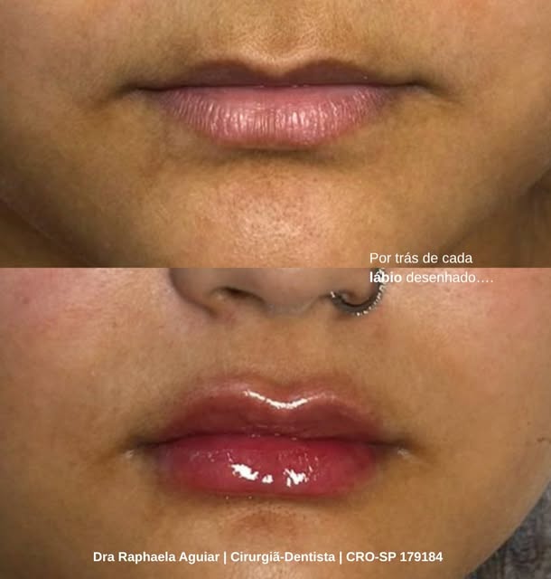 Contorno labial finalizado após preenchimento com ácido hialurônico