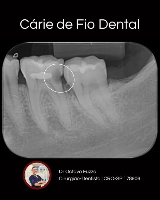 Radiografia panorâmica usada no planejamento de extração dentária