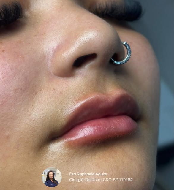 Perfil facial harmonioso após harmonização no Instituto Fuzzo