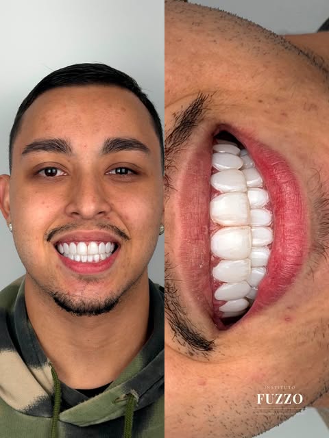 Antes e depois de lentes em resina