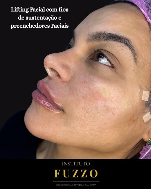 Lifting facial com fios de sustentação