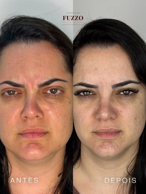Antes e depois de toxina botulínica