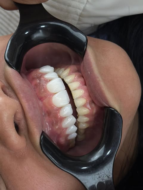 Dentes finalizados após tratamento clareador