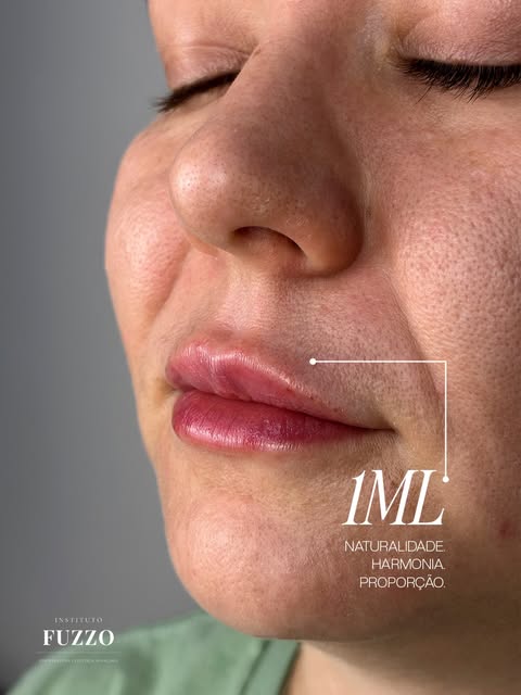 Preenchimento labial de 1 ml com naturalidade, harmonia e proporção
