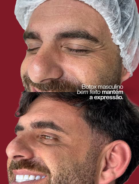 Botox masculino mantém a expressão