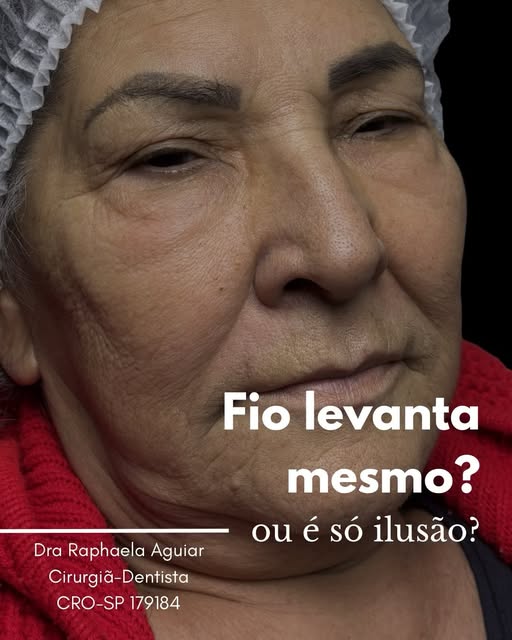 Fio levanta mesmo? Resultado de fios de sustentação em paciente madura