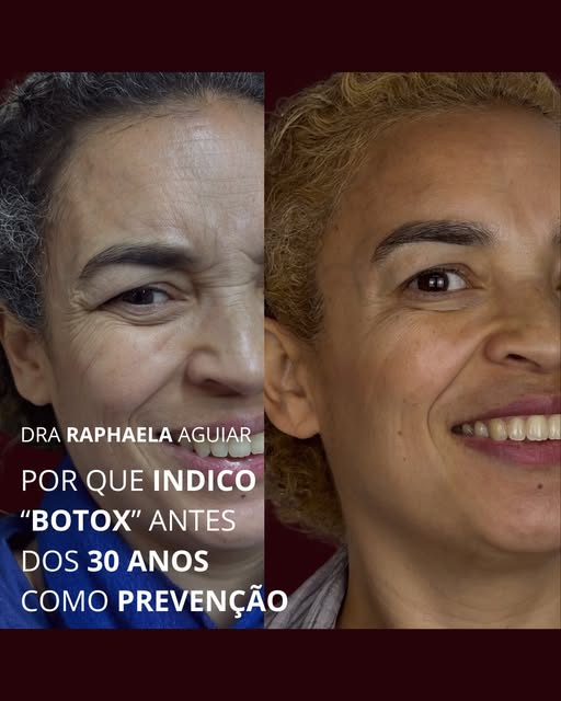 Botox antes dos 30 como prevenção