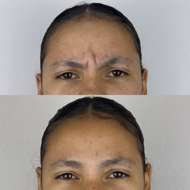 Rugas suavizadas após plano de harmonização facial no Instituto Fuzzo